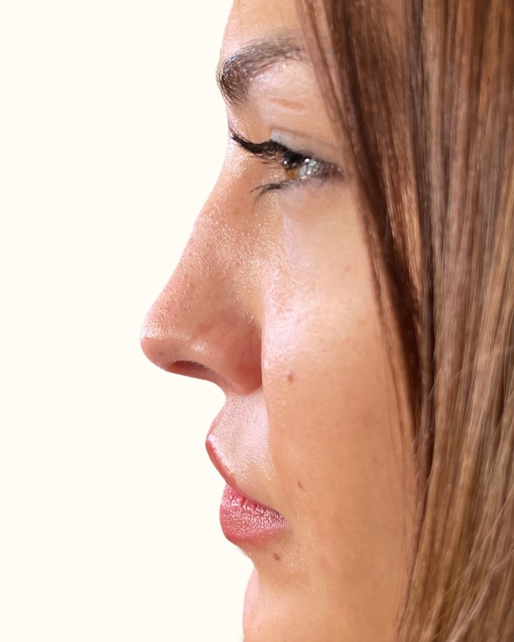 Nose, case 8 of 14: before