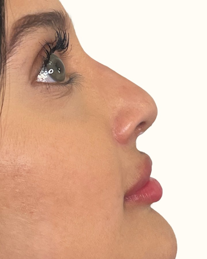 Nose, case 9 of 14: before