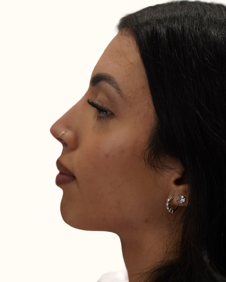Profile balancing, case 1 of 7: after