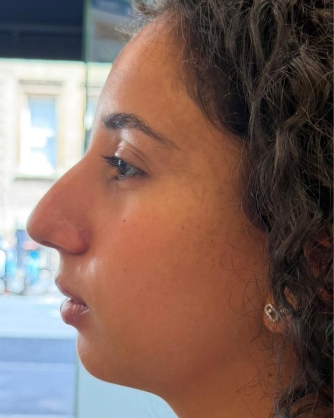 Profile balancing, case 4 of 7: before