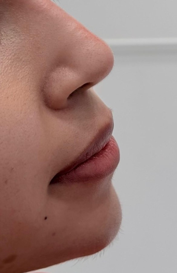 Profile balancing, case 5 of 7: after