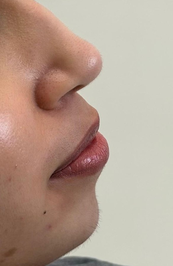 Profile balancing, case 5 of 7: before