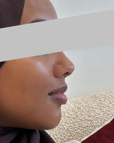 Profile balancing, case 6 of 7: after