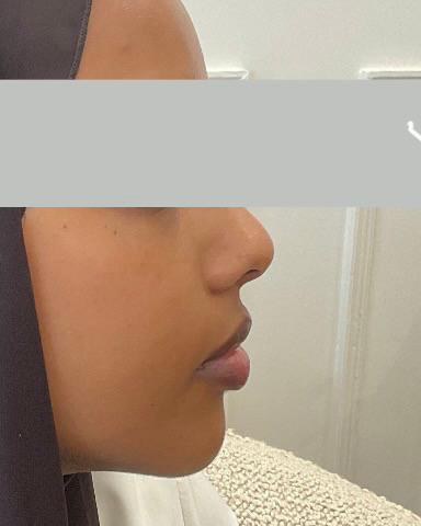 Profile balancing, case 6 of 7: before