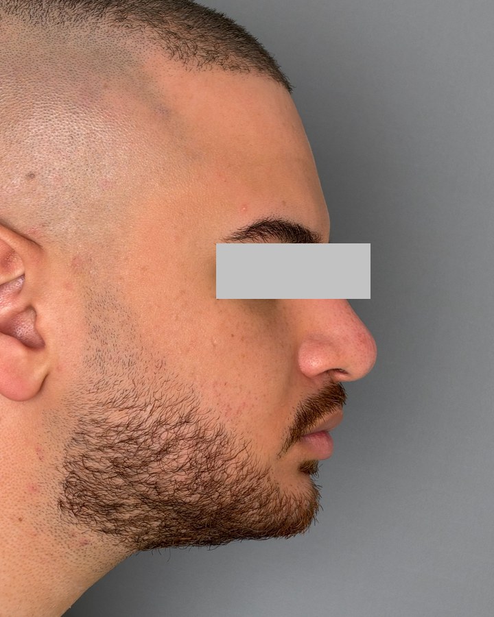 Profile balancing, case 7 of 7: after