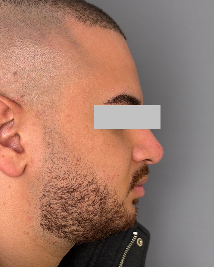 Profile balancing, case 7 of 7: before