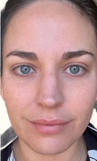 Tretinoin, case 1 of 3: after