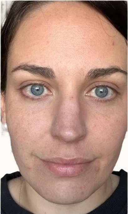Tretinoin, case 1 of 3: before