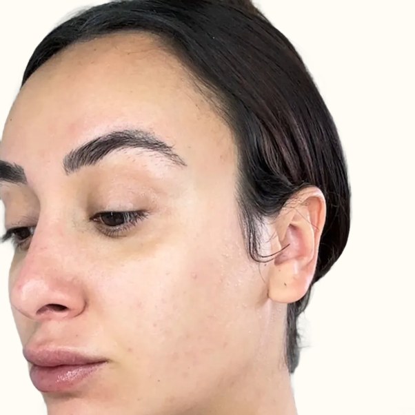 Tretinoin, case 2 of 3: after