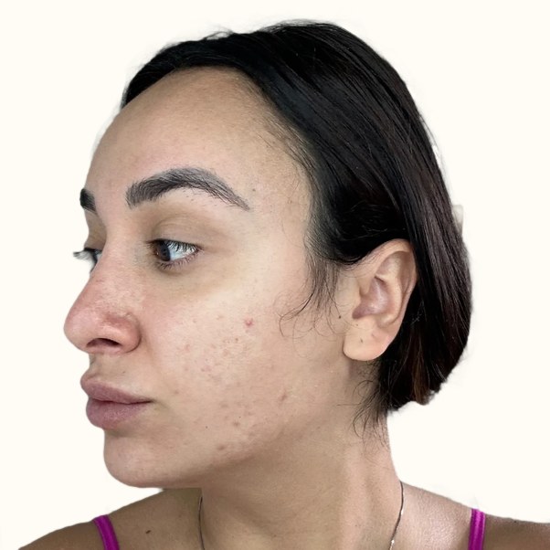 Tretinoin, case 2 of 3: before