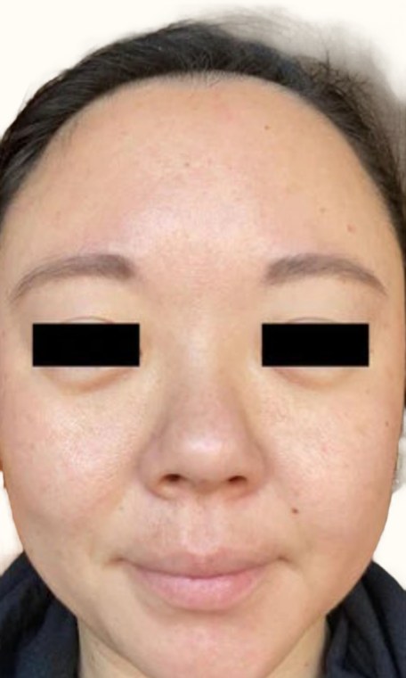 Tretinoin, case 3 of 3: after