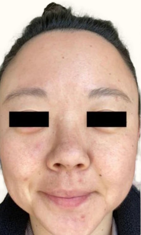 Tretinoin, case 3 of 3: before