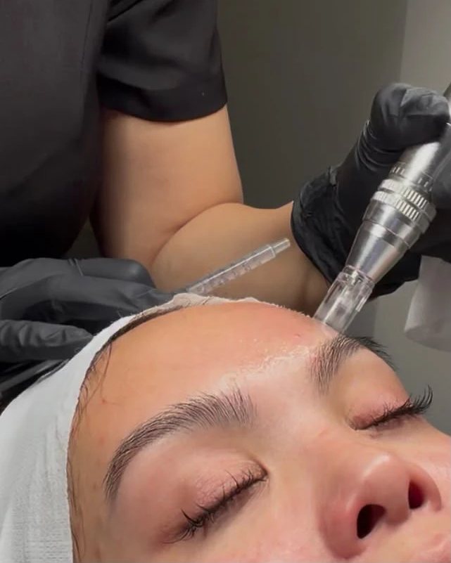 Advanced Microneedling at By Narjis