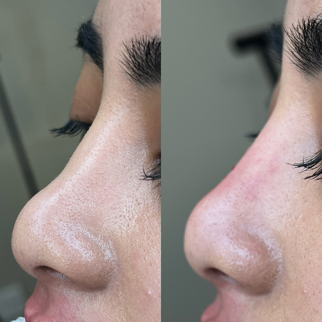 Nose Filler Package