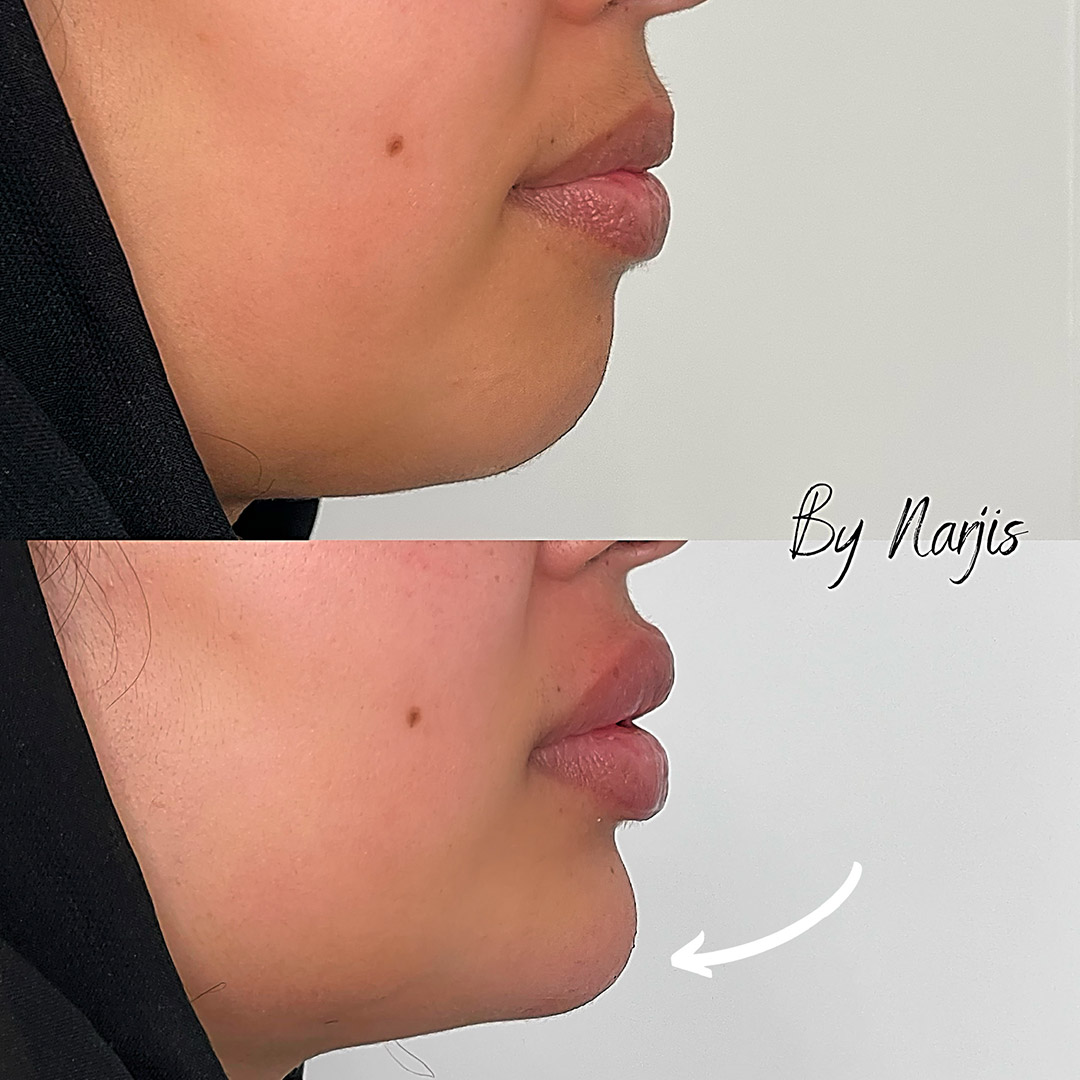 Jaw & Chin Filler
