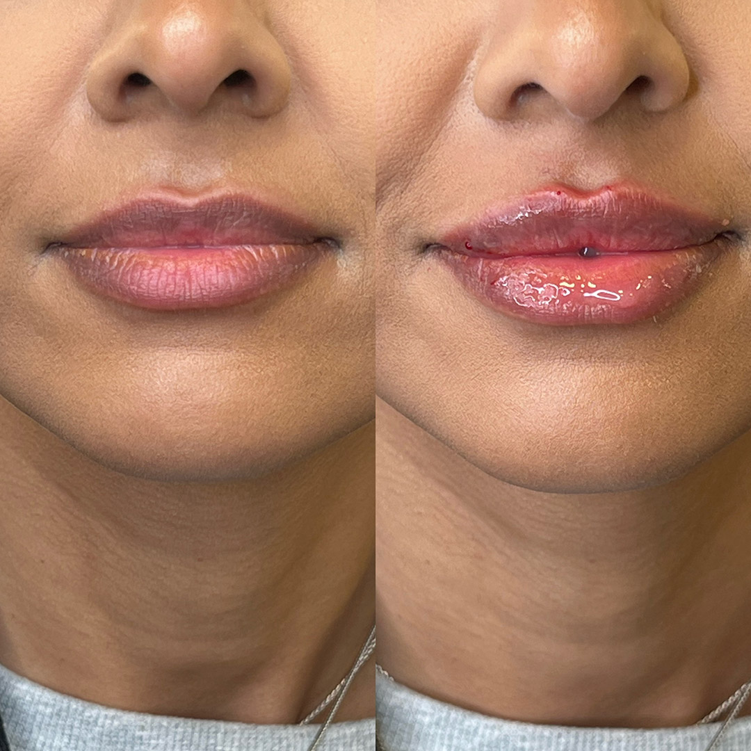 Lip Enhancement