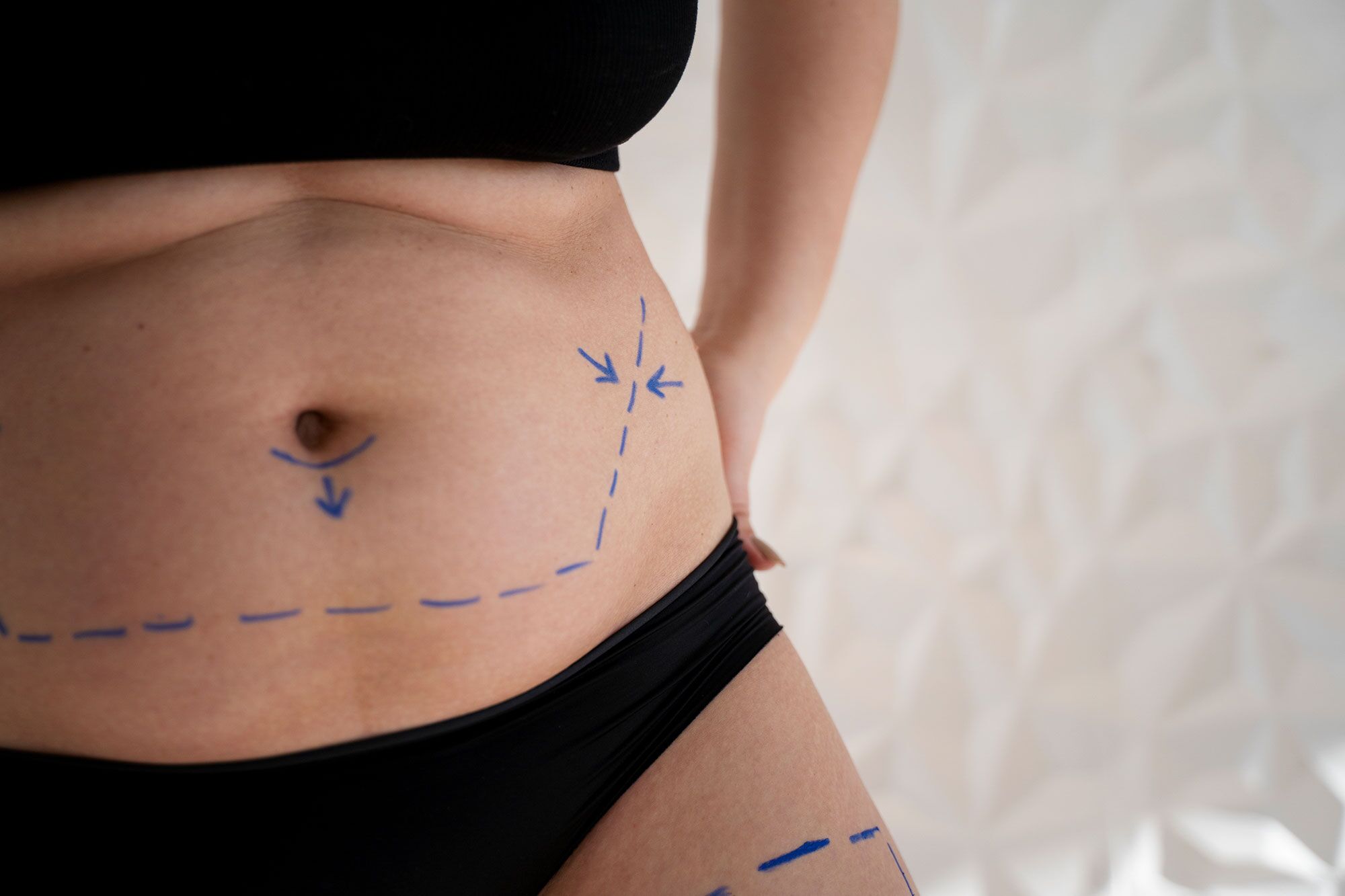 Liposuction
