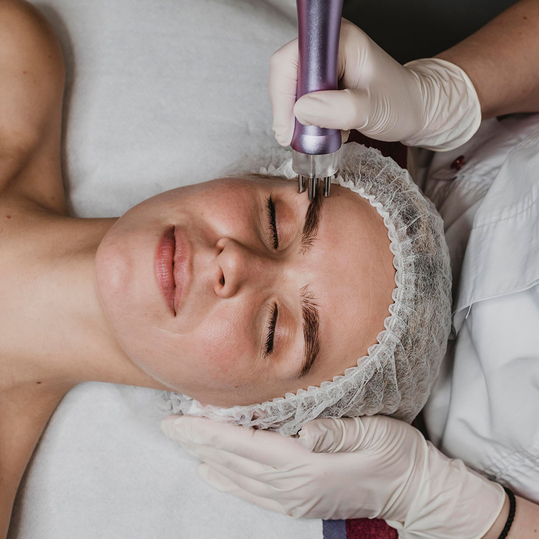 Micro-needling