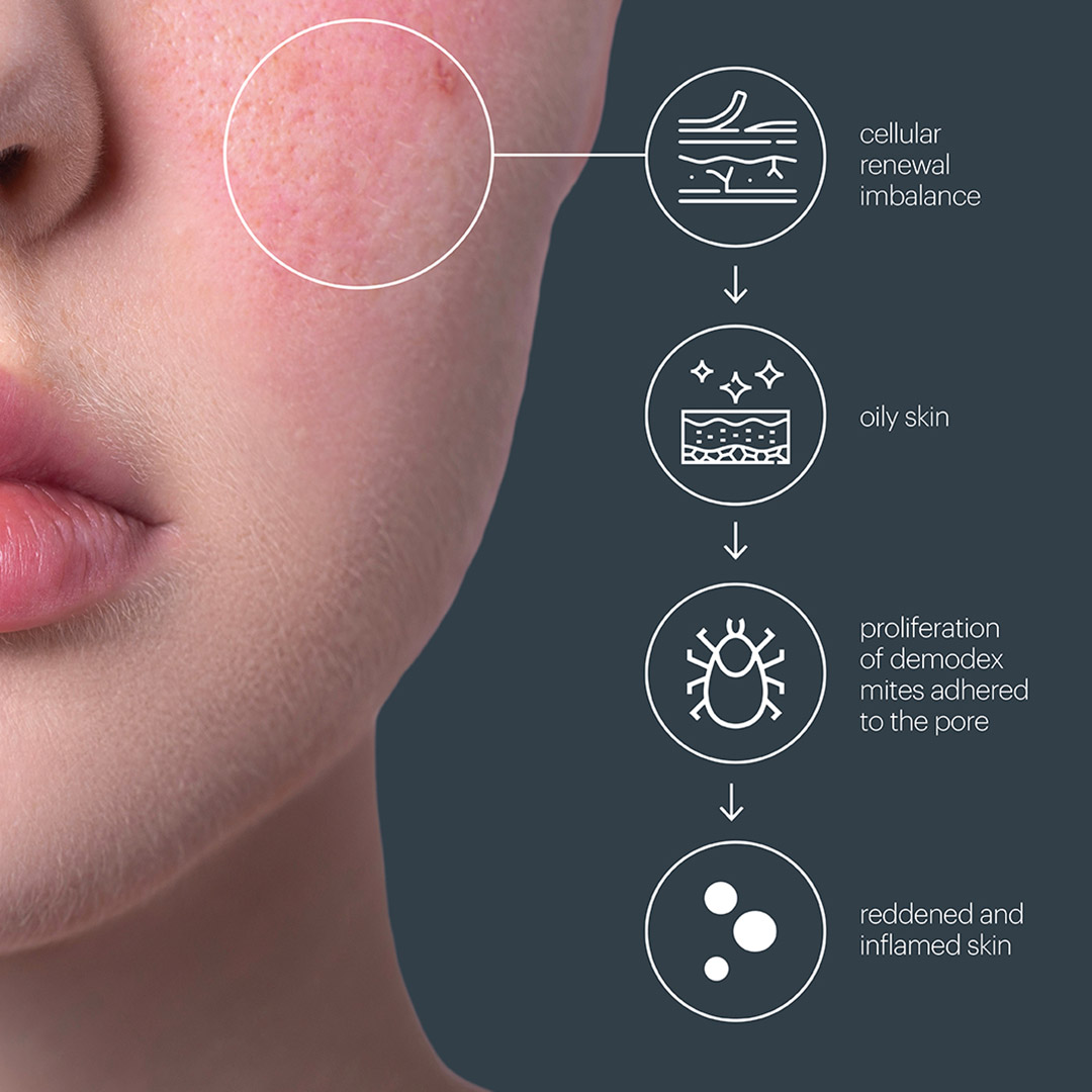 Chemical Peels